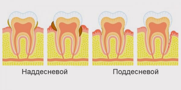 разновидности зубного камня